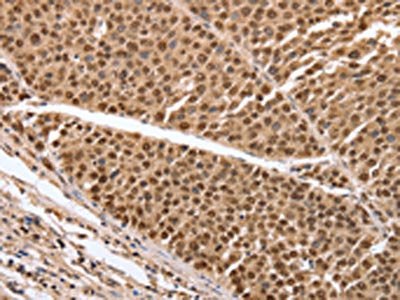 The image on the left is immunohistochemistry of paraffin-embedded Human liver cancer tissue using CSB-PA966699(PARP1 Antibody) at dilution 1/20, on the right is treated with synthetic peptide. (Original magnification: ×200)