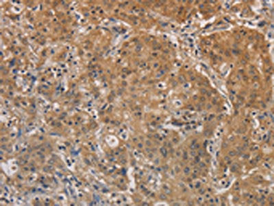 The image on the left is immunohistochemistry of paraffin-embedded Human gastic cancer tissue using CSB-PA966804(AGTRAP Antibody) at dilution 1/20, on the right is treated with fusion protein. (Original magnification: ×200)