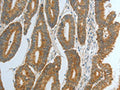 The image on the left is immunohistochemistry of paraffin-embedded Human colon cancer tissue using CSB-PA967082(DNAJC10 Antibody) at dilution 1/15, on the right is treated with fusion protein. (Original magnification: ×200)