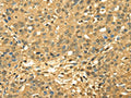 The image on the left is immunohistochemistry of paraffin-embedded Human breast cancer tissue using CSB-PA967113(RPA2 Antibody) at dilution 1/45, on the right is treated with fusion protein. (Original magnification: ×200)