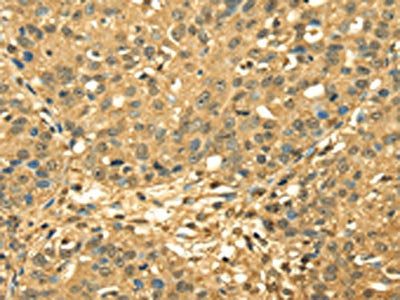 The image on the left is immunohistochemistry of paraffin-embedded Human breast cancer tissue using CSB-PA967113(RPA2 Antibody) at dilution 1/45, on the right is treated with fusion protein. (Original magnification: ×200)