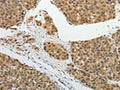 The image on the left is immunohistochemistry of paraffin-embedded Human liver cancer tissue using CSB-PA967586(PSMD14 Antibody) at dilution 1/25, on the right is treated with fusion protein. (Original magnification: ×200)