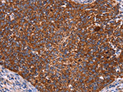 The image on the left is immunohistochemistry of paraffin-embedded Human cervical cancer tissue using CSB-PA967648(CROT Antibody) at dilution 1/50, on the right is treated with fusion protein. (Original magnification: ×200)