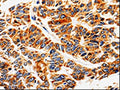 The image on the left is immunohistochemistry of paraffin-embedded Human lung cancer tissue using CSB-PA967715(ABCB5 Antibody) at dilution 1/10, on the right is treated with fusion protein. (Original magnification: ×200)
