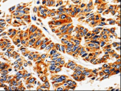 The image on the left is immunohistochemistry of paraffin-embedded Human lung cancer tissue using CSB-PA967715(ABCB5 Antibody) at dilution 1/10, on the right is treated with fusion protein. (Original magnification: ×200)
