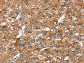 The image on the left is immunohistochemistry of paraffin-embedded Human liver cancer tissue using CSB-PA967887(AKR1C4 Antibody) at dilution 1/30, on the right is treated with fusion protein. (Original magnification: ×200)