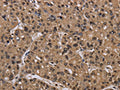 The image on the left is immunohistochemistry of paraffin-embedded Human liver cancer tissue using CSB-PA967899(CSNK2A1 Antibody) at dilution 1/30, on the right is treated with fusion protein. (Original magnification: ×200)