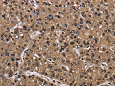 The image on the left is immunohistochemistry of paraffin-embedded Human liver cancer tissue using CSB-PA967899(CSNK2A1 Antibody) at dilution 1/30, on the right is treated with fusion protein. (Original magnification: ×200)