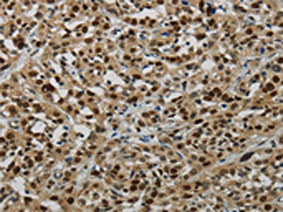 The image on the left is immunohistochemistry of paraffin-embedded Human esophagus cancer tissue using CSB-PA968357(LIG1 Antibody) at dilution 1/70, on the right is treated with fusion protein. (Original magnification: ×200)
