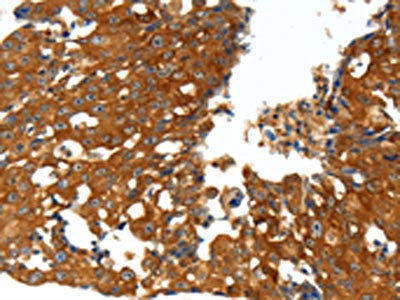 The image on the left is immunohistochemistry of paraffin-embedded Human breast cancer tissue using CSB-PA968386(CXCL12 Antibody) at dilution 1/20, on the right is treated with synthetic peptide. (Original magnification: ×200)