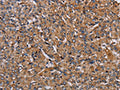 The image on the left is immunohistochemistry of paraffin-embedded Human prostate cancer tissue using CSB-PA968396(HIF1A Antibody) at dilution 1/40, on the right is treated with fusion protein. (Original magnification: ×200)