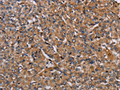 The image on the left is immunohistochemistry of paraffin-embedded Human prostate cancer tissue using CSB-PA968396(HIF1A Antibody) at dilution 1/40, on the right is treated with fusion protein. (Original magnification: ×200)
