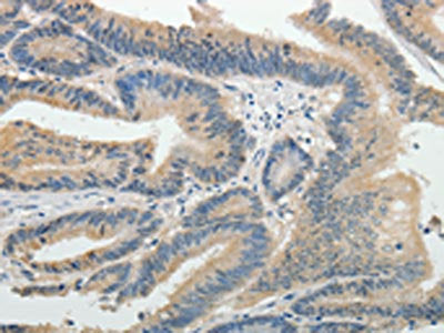 The image on the left is immunohistochemistry of paraffin-embedded Human colon cancer tissue using CSB-PA968757(BIRC5 Antibody) at dilution 1/25, on the right is treated with fusion protein. (Original magnification: ×200)