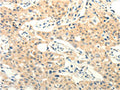 The image on the left is immunohistochemistry of paraffin-embedded Human lung cancer tissue using CSB-PA968818(FOXR2 Antibody) at dilution 1/25, on the right is treated with fusion protein. (Original magnification: ×200)