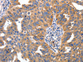 The image on the left is immunohistochemistry of paraffin-embedded Human ovarian cancer tissue using CSB-PA969280(IRS2 Antibody) at dilution 1/100, on the right is treated with synthetic peptide. (Original magnification: ×200)