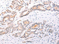 The image on the left is immunohistochemistry of paraffin-embedded Human colon cancer tissue using CSB-PA969451(TRAF3IP1 Antibody) at dilution 1/50, on the right is treated with fusion protein. (Original magnification: ×200)