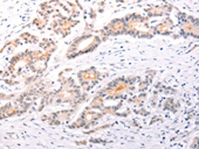 The image on the left is immunohistochemistry of paraffin-embedded Human colon cancer tissue using CSB-PA969451(TRAF3IP1 Antibody) at dilution 1/50, on the right is treated with fusion protein. (Original magnification: ×200)
