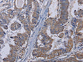 The image on the left is immunohistochemistry of paraffin-embedded Human esophagus cancer tissue using CSB-PA969456(TRPM8 Antibody) at dilution 1/30, on the right is treated with fusion protein. (Original magnification: ×200)