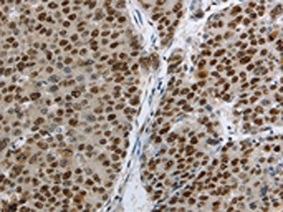 The image on the left is immunohistochemistry of paraffin-embedded Human liver cancer tissue using CSB-PA969629(MCM3 Antibody) at dilution 1/30, on the right is treated with fusion protein. (Original magnification: ×200)