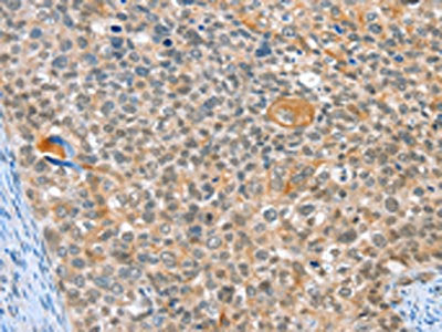 The image on the left is immunohistochemistry of paraffin-embedded Human cervical cancer tissue using CSB-PA969647(ALDOB Antibody) at dilution 1/40, on the right is treated with synthetic peptide. (Original magnification: ×200)