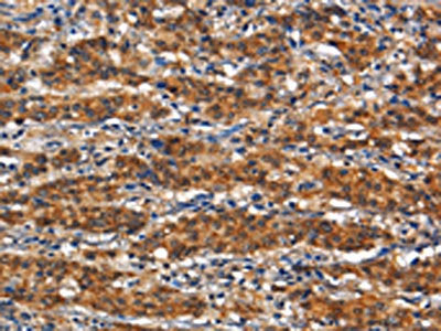 The image on the left is immunohistochemistry of paraffin-embedded Human gastic cancer tissue using CSB-PA969898(ANPEP Antibody) at dilution 1/80, on the right is treated with synthetic peptide. (Original magnification: ×200)