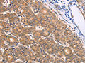 The image on the left is immunohistochemistry of paraffin-embedded Human thyroid cancer tissue using CSB-PA969912(BTG3 Antibody) at dilution 1/15, on the right is treated with fusion protein. (Original magnification: ×200)