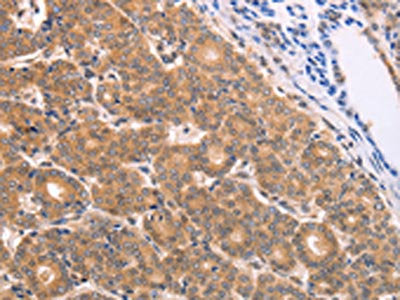 The image on the left is immunohistochemistry of paraffin-embedded Human thyroid cancer tissue using CSB-PA969912(BTG3 Antibody) at dilution 1/15, on the right is treated with fusion protein. (Original magnification: ×200)