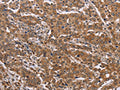 The image on the left is immunohistochemistry of paraffin-embedded Human liver cancer tissue using CSB-PA969975(FAAH2 Antibody) at dilution 1/30, on the right is treated with fusion protein. (Original magnification: ×200)