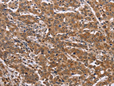 The image on the left is immunohistochemistry of paraffin-embedded Human liver cancer tissue using CSB-PA969975(FAAH2 Antibody) at dilution 1/30, on the right is treated with fusion protein. (Original magnification: ×200)