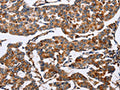 The image on the left is immunohistochemistry of paraffin-embedded Human breast cancer tissue using CSB-PA970254(ENPP5 Antibody) at dilution 1/60, on the right is treated with fusion protein. (Original magnification: ×200)
