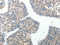 The image on the left is immunohistochemistry of paraffin-embedded Human liver cancer tissue using CSB-PA970308(ABI3BP Antibody) at dilution 1/20, on the right is treated with synthetic peptide. (Original magnification: ×200)