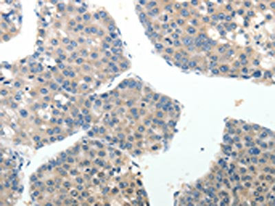 The image on the left is immunohistochemistry of paraffin-embedded Human liver cancer tissue using CSB-PA970308(ABI3BP Antibody) at dilution 1/20, on the right is treated with synthetic peptide. (Original magnification: ×200)
