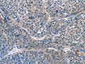 The image on the left is immunohistochemistry of paraffin-embedded Human liver cancer tissue using CSB-PA970433(AKR1D1 Antibody) at dilution 1/25, on the right is treated with fusion protein. (Original magnification: ×200)
