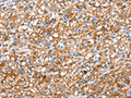 The image on the left is immunohistochemistry of paraffin-embedded Human prostate cancer tissue using CSB-PA970469(ABCC8 Antibody) at dilution 1/40, on the right is treated with synthetic peptide. (Original magnification: ×200)