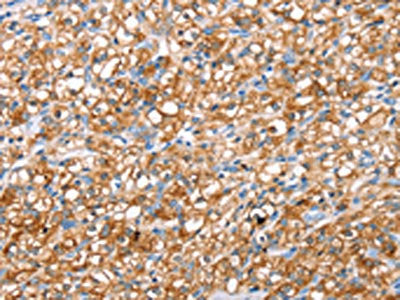 The image on the left is immunohistochemistry of paraffin-embedded Human prostate cancer tissue using CSB-PA970469(ABCC8 Antibody) at dilution 1/40, on the right is treated with synthetic peptide. (Original magnification: ×200)