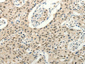 The image on the left is immunohistochemistry of paraffin-embedded Human lung cancer tissue using CSB-PA970487(FZD10 Antibody) at dilution 1/50, on the right is treated with synthetic peptide. (Original magnification: ×200)