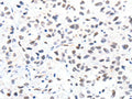 The image on the left is immunohistochemistry of paraffin-embedded Human lung cancer tissue using CSB-PA970548(SLC2A4 Antibody) at dilution 1/15, on the right is treated with synthetic peptide. (Original magnification: ×200)