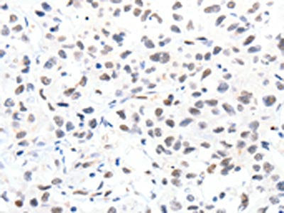 The image on the left is immunohistochemistry of paraffin-embedded Human lung cancer tissue using CSB-PA970548(SLC2A4 Antibody) at dilution 1/15, on the right is treated with synthetic peptide. (Original magnification: ×200)