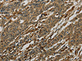 The image on the left is immunohistochemistry of paraffin-embedded Human gastric cancer tissue using CSB-PA970771(AIF1 Antibody) at dilution 1/50, on the right is treated with fusion protein. (Original magnification: ×200)