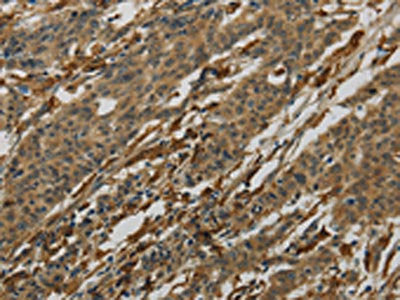 The image on the left is immunohistochemistry of paraffin-embedded Human gastric cancer tissue using CSB-PA970771(AIF1 Antibody) at dilution 1/50, on the right is treated with fusion protein. (Original magnification: ×200)