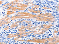 The image on the left is immunohistochemistry of paraffin-embedded Human stomach cancer tissue using CSB-PA971102(GDF9 Antibody) at dilution 1/7, on the right is treated with fusion protein. (Original magnification: ×200)