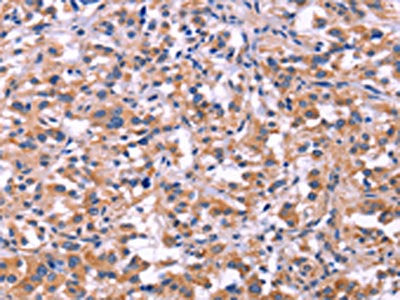 The image on the left is immunohistochemistry of paraffin-embedded Human thyroid cancer tissue using CSB-PA971298(MMP14 Antibody) at dilution 1/40, on the right is treated with fusion protein. (Original magnification: ×200)