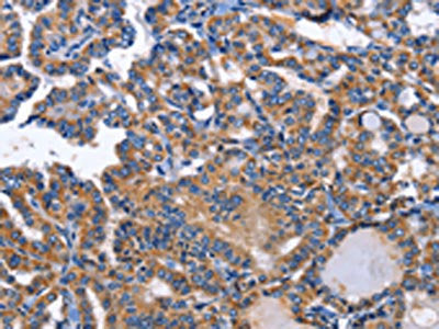 The image on the left is immunohistochemistry of paraffin-embedded Human thyroid cancer tissue using CSB-PA971390(INHBC Antibody) at dilution 1/50, on the right is treated with fusion protein. (Original magnification: ×200)