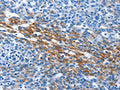 The image on the left is immunohistochemistry of paraffin-embedded Human ovarian cancer tissue using CSB-PA971648(PAK6 Antibody) at dilution 1/40, on the right is treated with fusion protein. (Original magnification: ×200)