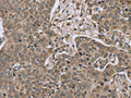 The image on the left is immunohistochemistry of paraffin-embedded Human liver cancer tissue using CSB-PA971812(IL15RA Antibody) at dilution 1/45, on the right is treated with synthetic peptide. (Original magnification: ×200)