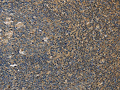 The image on the left is immunohistochemistry of paraffin-embedded Human tonsil tissue using CSB-PA972361(DDX19B Antibody) at dilution 1/20, on the right is treated with fusion protein. (Original magnification: ×200)