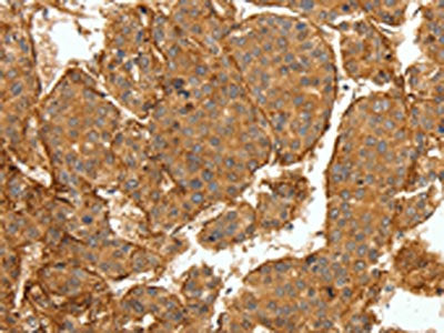The image on the left is immunohistochemistry of paraffin-embedded Human lung cancer tissue using CSB-PA972442(COL4A1 Antibody) at dilution 1/30, on the right is treated with synthetic peptide. (Original magnification: ×200)