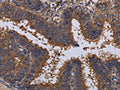 The image on the left is immunohistochemistry of paraffin-embedded Human colon cancer tissue using CSB-PA972492(MCTS1 Antibody) at dilution 1/30, on the right is treated with fusion protein. (Original magnification: ×200)