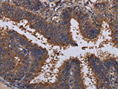 The image on the left is immunohistochemistry of paraffin-embedded Human colon cancer tissue using CSB-PA972492(MCTS1 Antibody) at dilution 1/30, on the right is treated with fusion protein. (Original magnification: ×200)