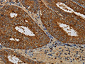 The image on the left is immunohistochemistry of paraffin-embedded Human colon cancer tissue using CSB-PA972784(KCNK17 Antibody) at dilution 1/60, on the right is treated with fusion protein. (Original magnification: ×200)